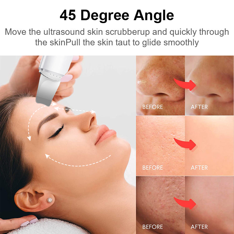 Face Blackhead Remover